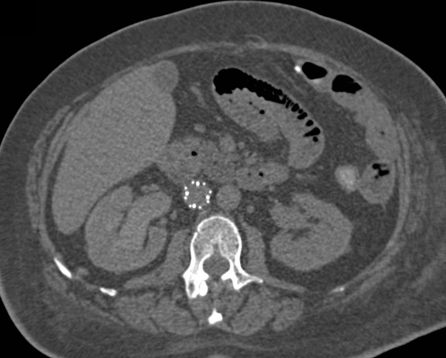 Multifocal Transitional Cell Carcinoma - CTisus CT Scan