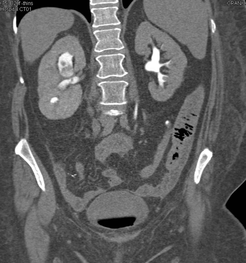 Transitional Cell Carcinoma of the Left Renal Pelvis - CTisus CT Scan