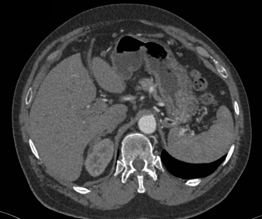 Bilateral Renal Cell Carcinomas with Prior Left Partial Nephrectomy - CTisus CT Scan