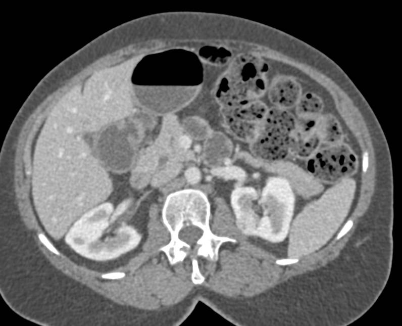 Subtle 1 cm Left Renal Cell Carcinoma - CTisus CT Scan