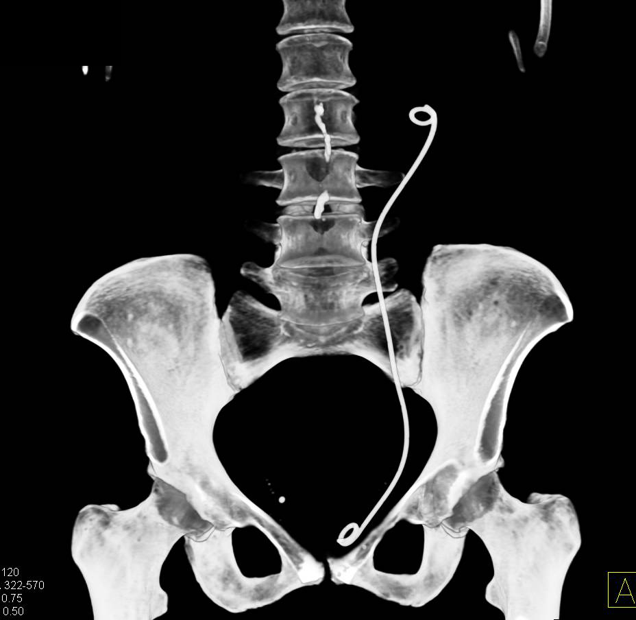 CT Urogram with a Ureteropelvic Junction (UPJ) in the Left Kidney - CTisus CT Scan