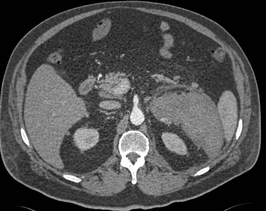 Right Renal Cell Carcinoma with Metastases and Bleed in the Left Adrenal Gland - CTisus CT Scan