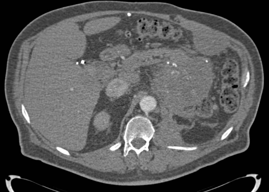 Recurrent Real Cell Cancer Invades the Left Renal Vein and Inferior Vena Cava (IVC) - CTisus CT Scan