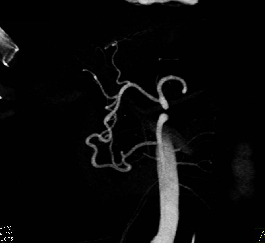 Retroperitoneal Bleed Extends Around the Right Kidney - CTisus CT Scan