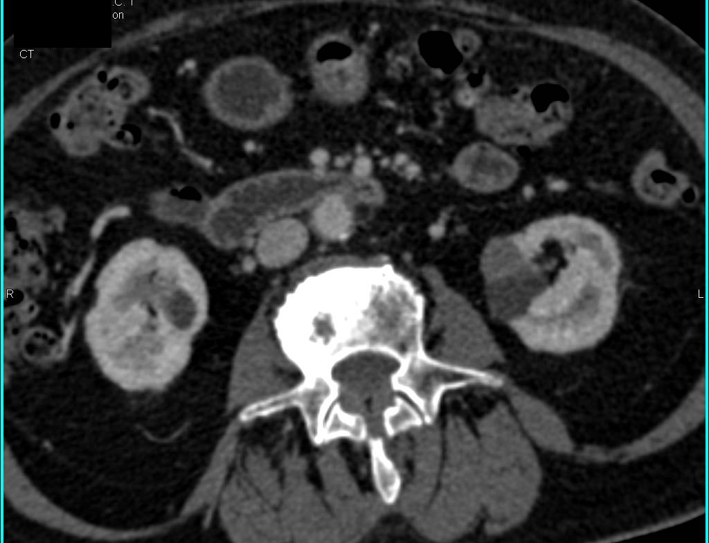 Papillary Renal Cell Carcinoma Arises in the Wall of a Cyst Seen in Multiple Phases and Projections - CTisus CT Scan