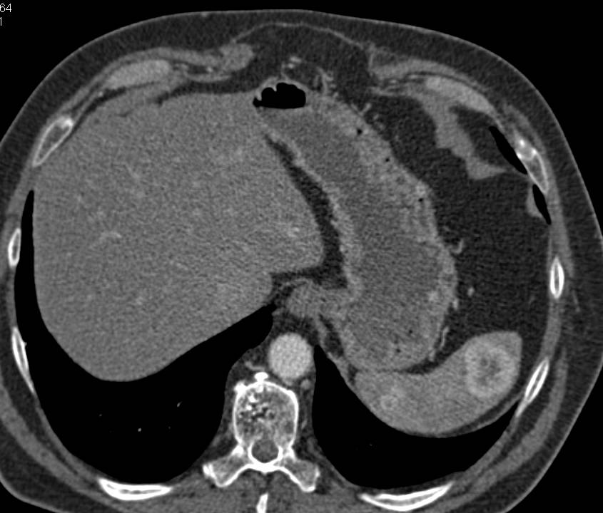 Metastatic Renal Cell Carcinoma to the Spleen - CTisus CT Scan