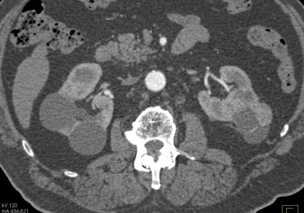 Renal Cell Carcinoma Arising in a Cyst Wall - CTisus CT Scan