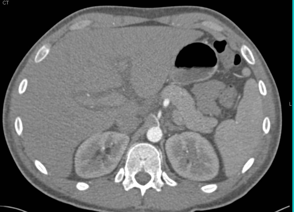 Excellent Example of Acute Pyelonephritis Only Seen on Delayed Phase Images - CTisus CT Scan