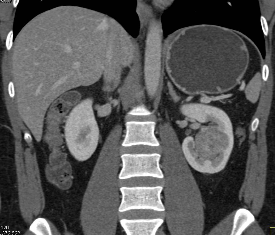 Papillary Left Renal Cell Carcinoma - CTisus CT Scan