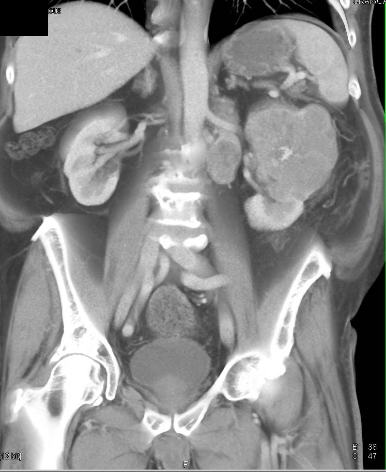 Renal Cell Carcinoma with Para-aortic Adenopathy - CTisus CT Scan