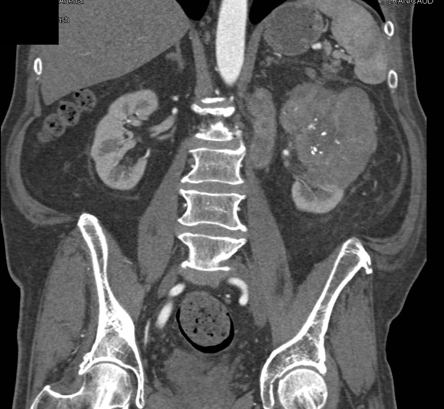 Clear Cell Renal Cell Carcinoma with Para-aortic Adenopathy - CTisus CT Scan