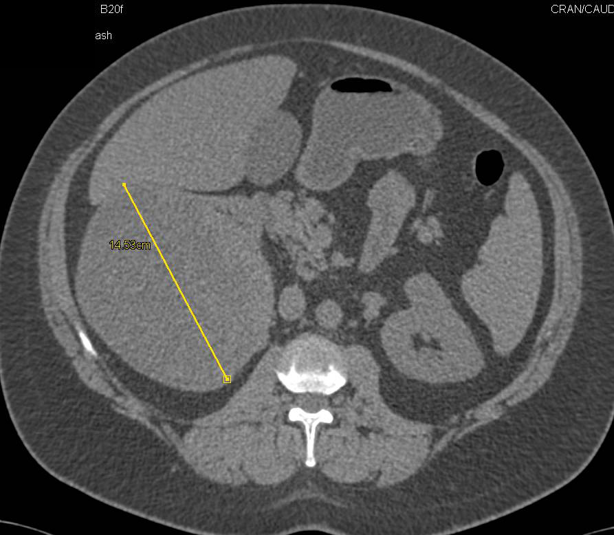 Cystic and Solid Renal Cell Carcinoma - CTisus CT Scan