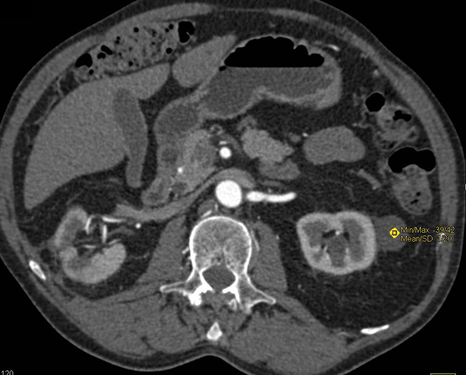 Excellent Example of a High Density Left Renal Cyst - CTisus CT Scan