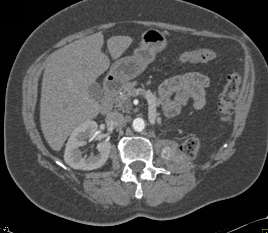 Recurrent Renal Cell Carcinoma Involves the Psoas Muscle and the L-Spine - CTisus CT Scan