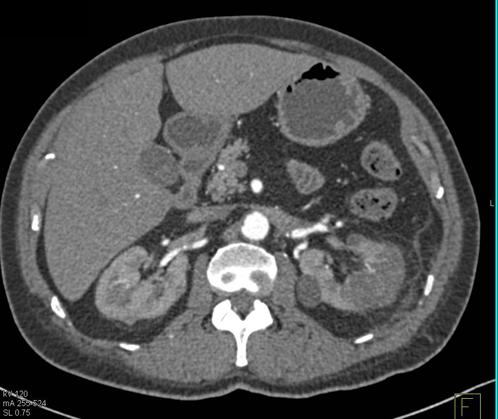 Multiple Bilateral Renal Cell Carcinomas - CTisus CT Scan