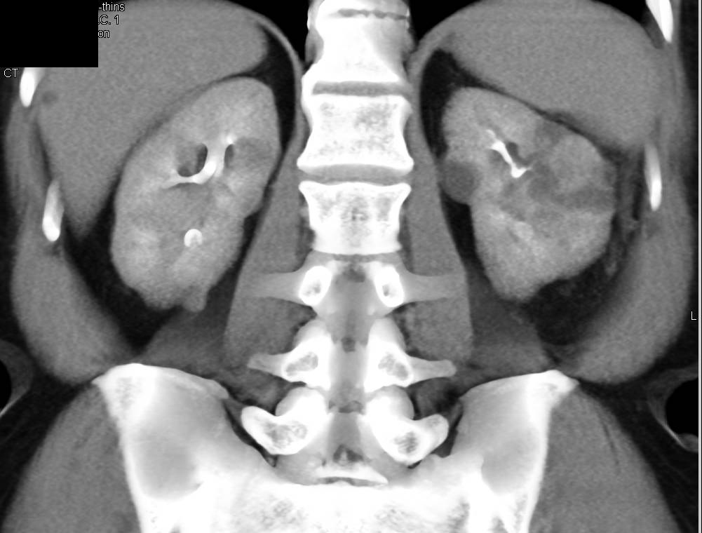 Unusual Appearance of Renal Lymphoma with Bilateral Masses and Decreased Enhanced - CTisus CT Scan