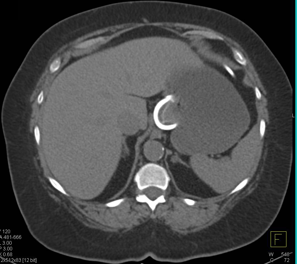 Lipid Poor Left Adrenal Adenoma - CTisus CT Scan