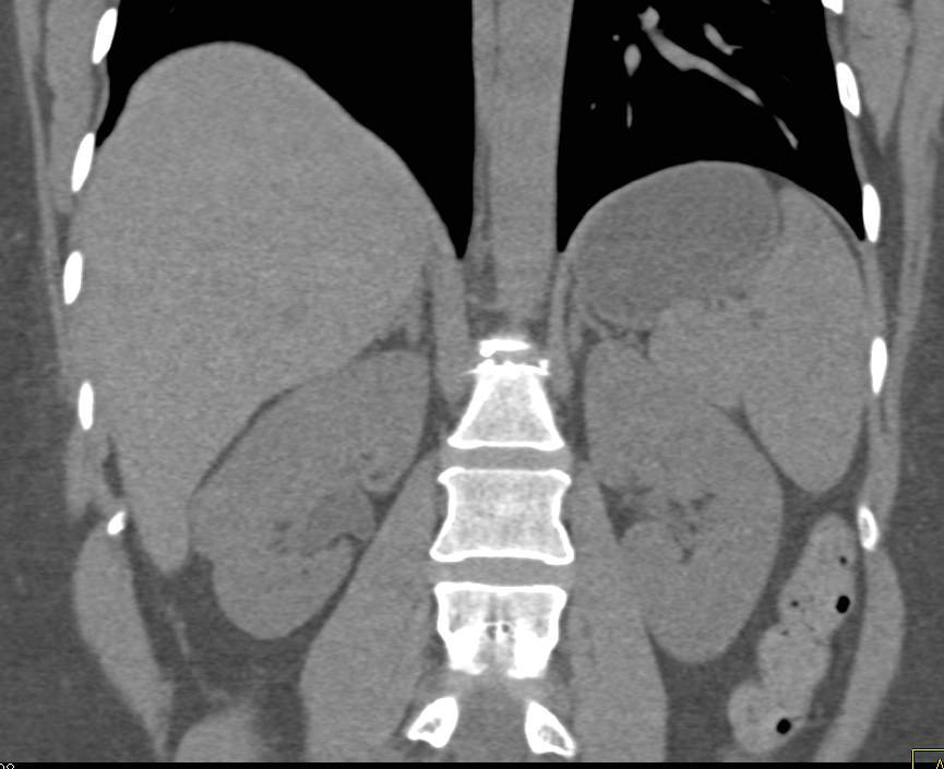 Focal Acute Pyelonephritis Simulates a Mass - CTisus CT Scan