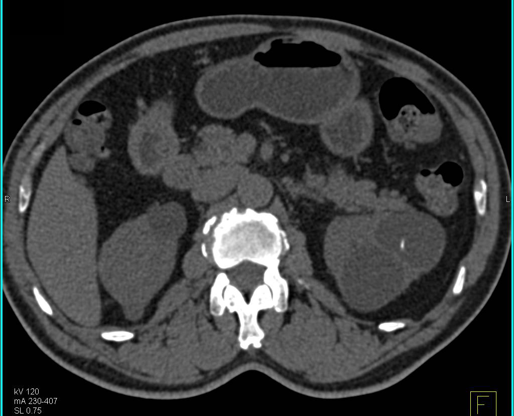 High Density Left Renal Cyst - CTisus CT Scan