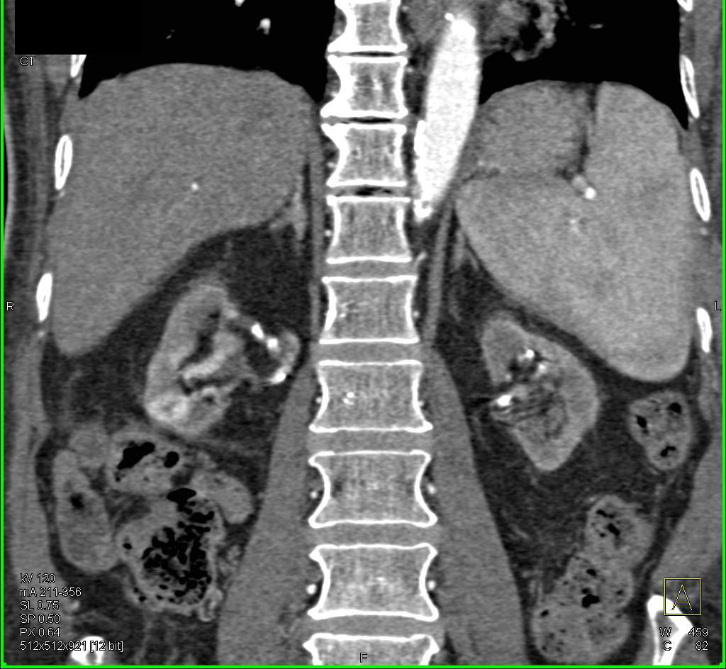 1 cm Right Renal Cell Carcinoma in a Patient with End Stage Renal Disease (ESRD) - CTisus CT Scan