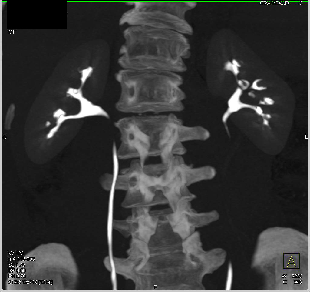 Normal Calyxl lAnatomy in 3D - CTisus CT Scan