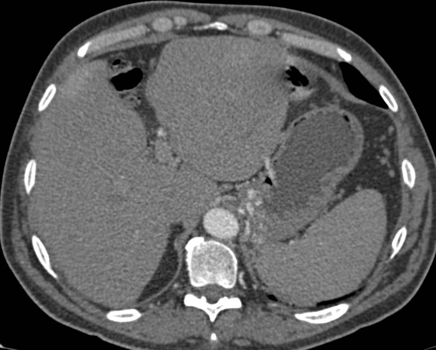 Recurrent Left Renal Cell Carcinoma with Local Recurrence, Adenopathy and Pancreatic Metastases - CTisus CT Scan