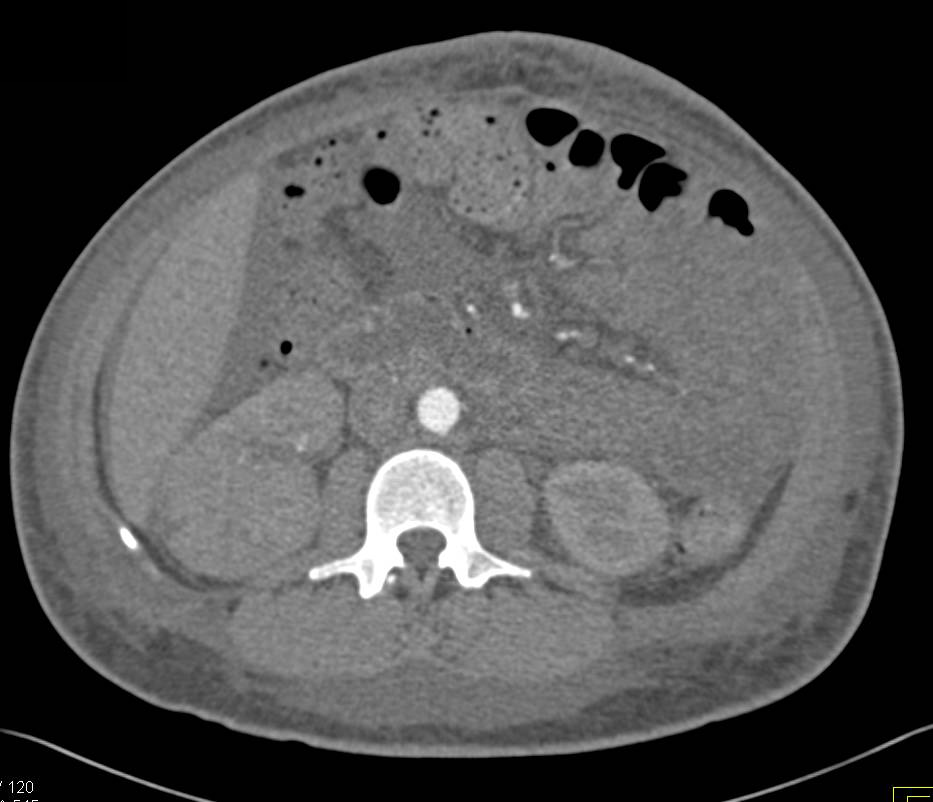 Acute Pyelonephritis Right Kidney with Blood Clots in the Ureter - CTisus CT Scan