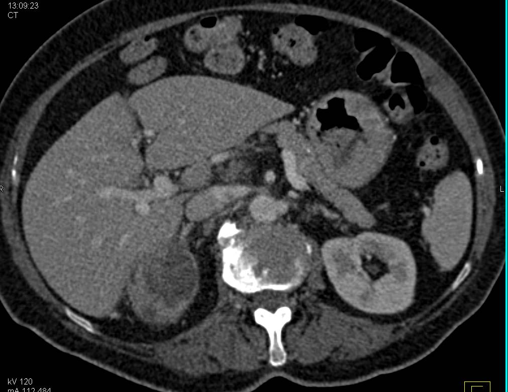 Necrotic Renal Cell Carcinoma with Clot in Left Innominate Vein - CTisus CT Scan