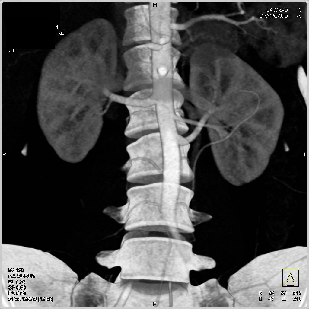 Renal Donor with Two Left Renal Arteries - CTisus CT Scan