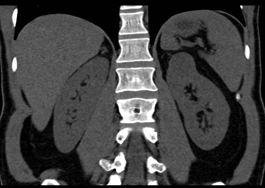 Cystic Left Renal Cell Carcinoma - CTisus CT Scan