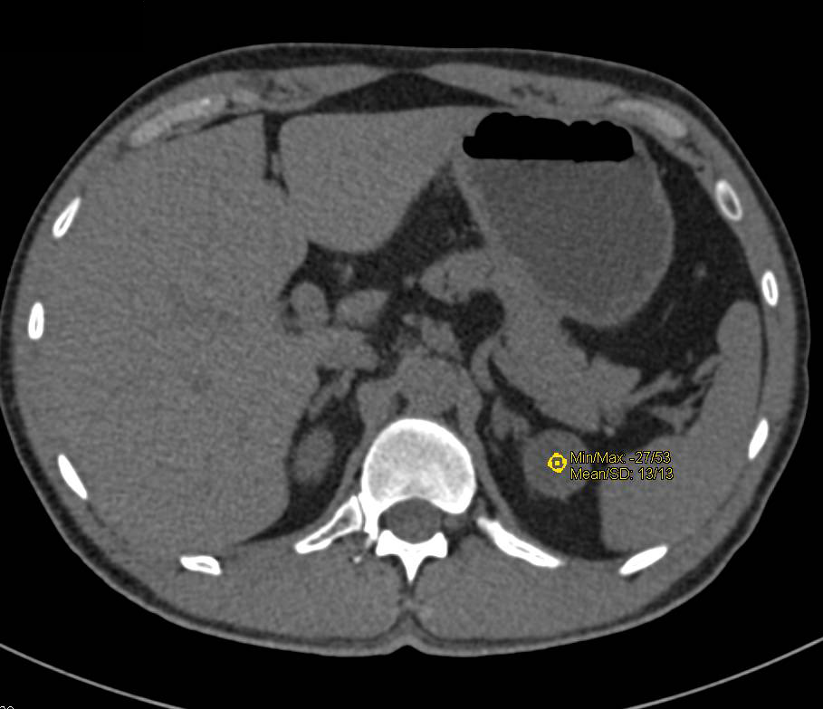 High Density Upper Pole Left Kidney - CTisus CT Scan