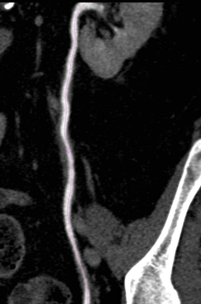 Transitional Cell Carcinoma of the Left Ureter - CTisus CT Scan