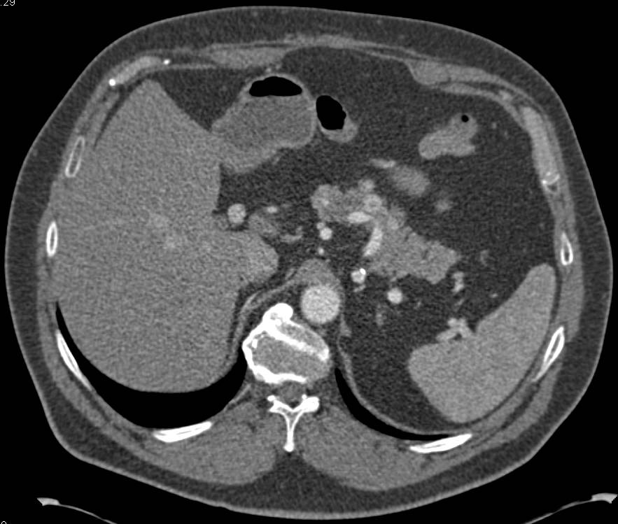 Recurrent Renal Cell Carcinoma Metastatic to the Pancreas and Spleen - CTisus CT Scan