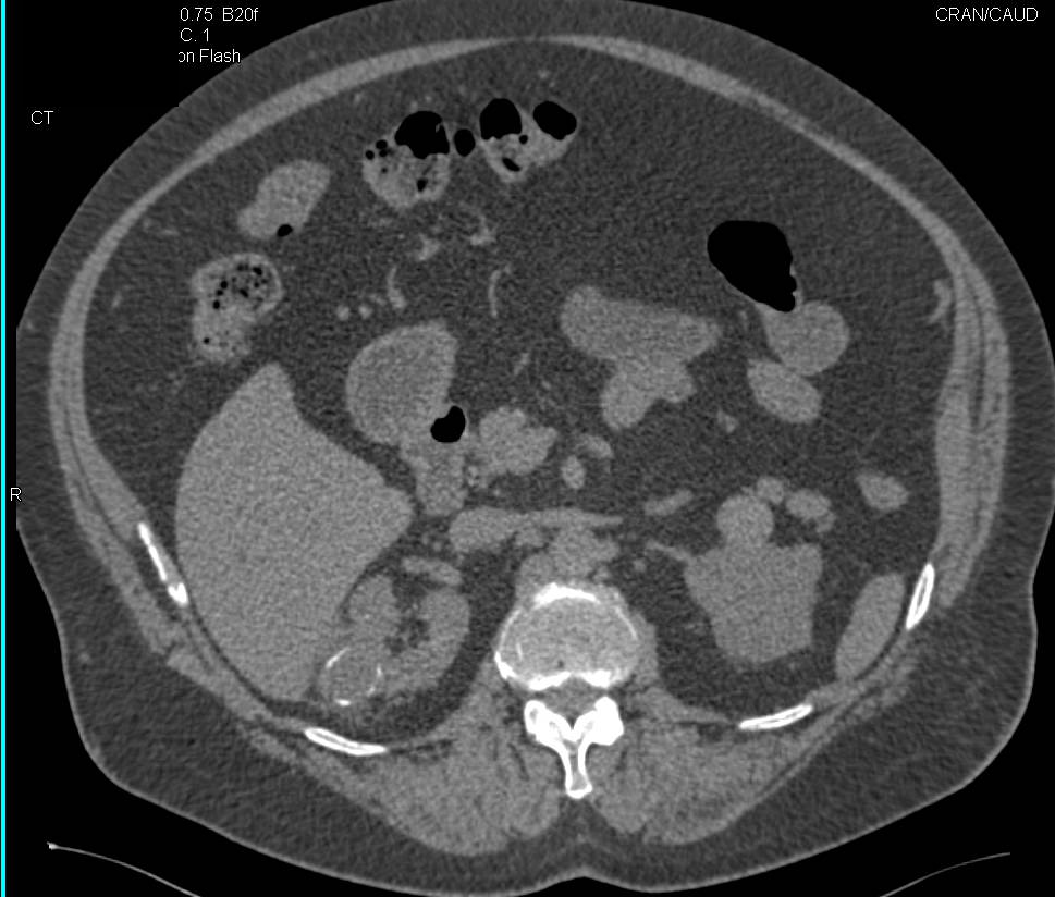 Complex Right Renal Cyst with Calcification - Kidney Case Studies ...