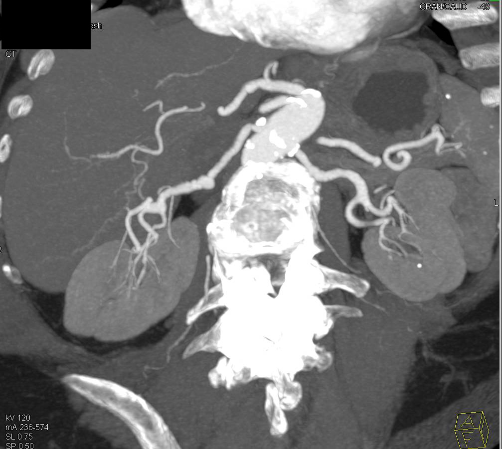 FMD (Fibromuscular Dysplasia) of the Right Renal Artery and Right Angiomyolipoma - CTisus CT Scan