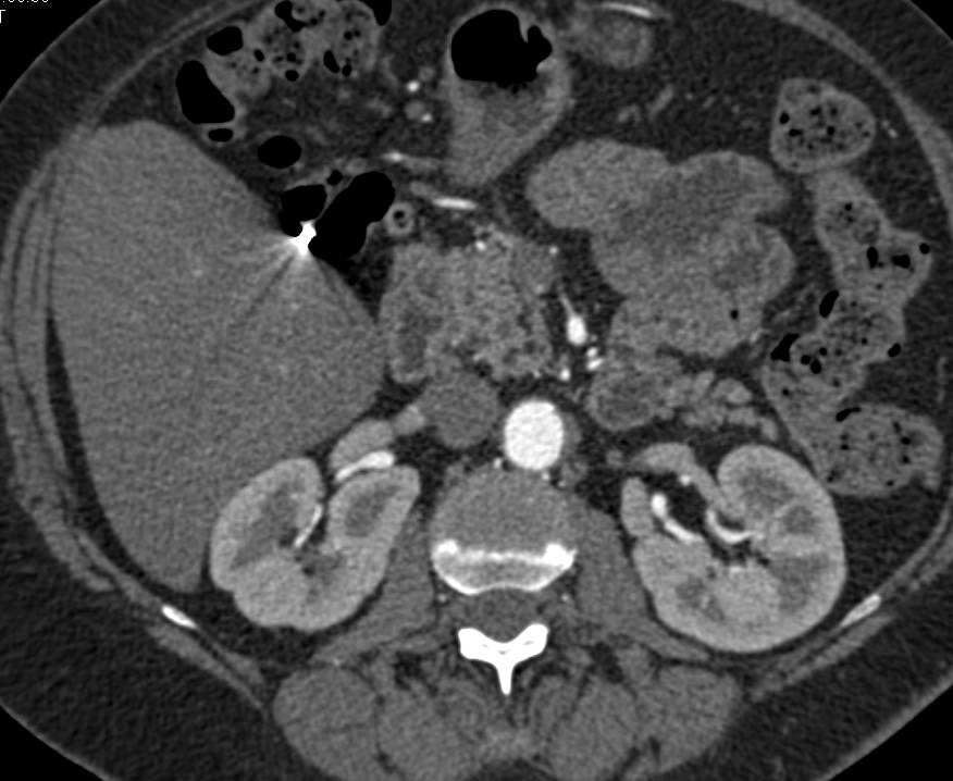 Mild Lobulations Right Kidney - Kidney Case Studies - CTisus CT Scanning