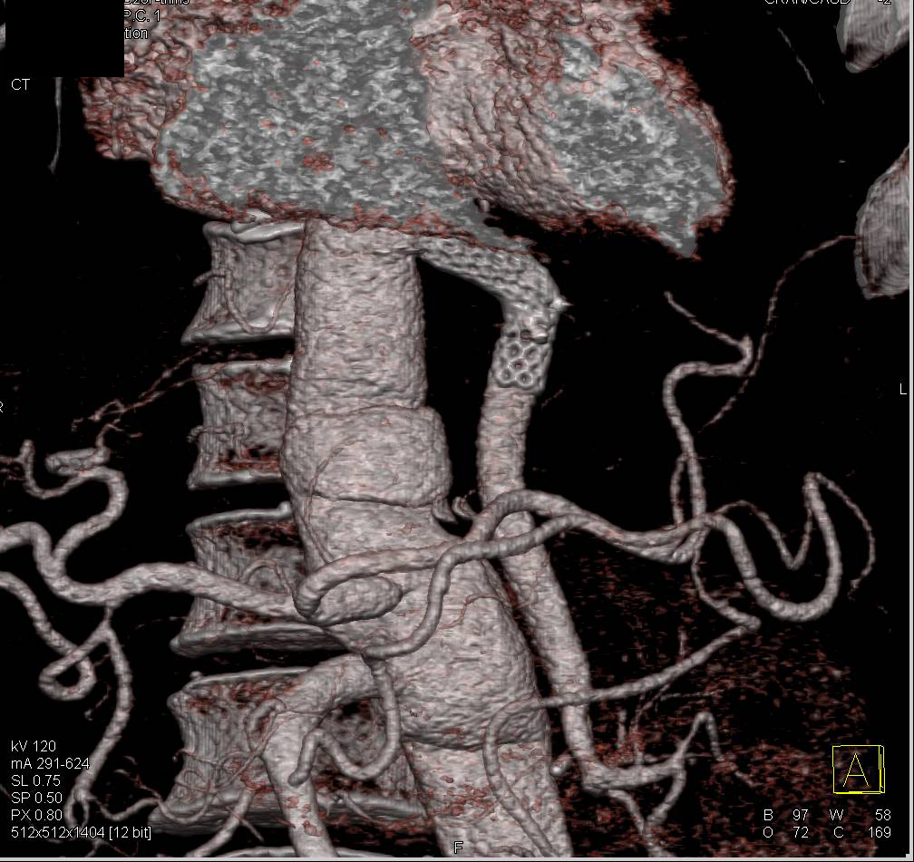 Aneurysm Repair with Graft to the Renal Artery - CTisus CT Scan