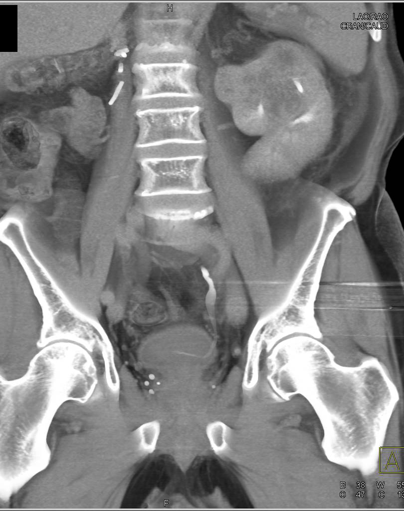 Renal Cell Carcinoma Recurs in the Contralateral Kidney - CTisus CT Scan