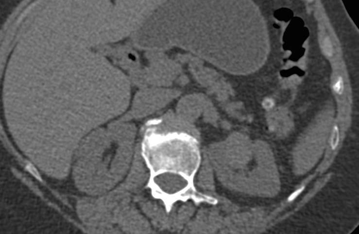 Clear Cell Renal Cell Carcinoma - CTisus CT Scan