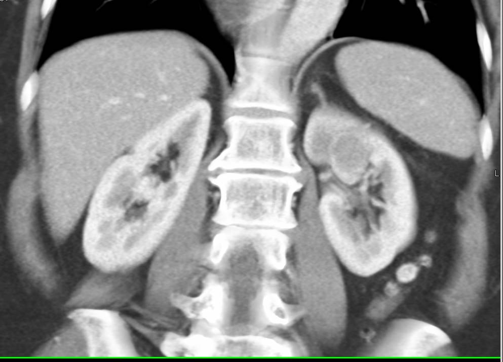 Papillary Left Renal Cell Carcinoma - CTisus CT Scan