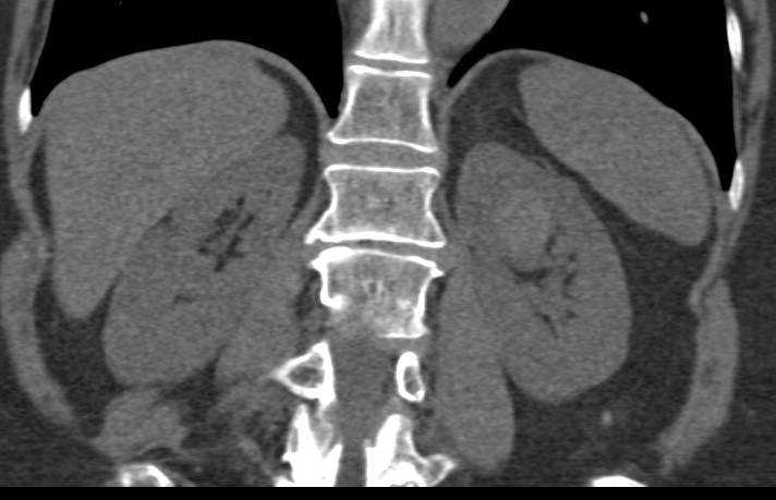 Clear Cell Renal Cell Carcinoma - CTisus CT Scan