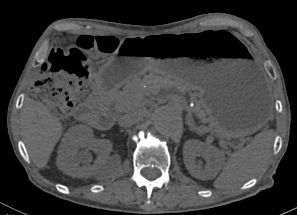 Renal Cell Carcinoma Right Kidney and Prostatic Hypertrophy - CTisus CT Scan