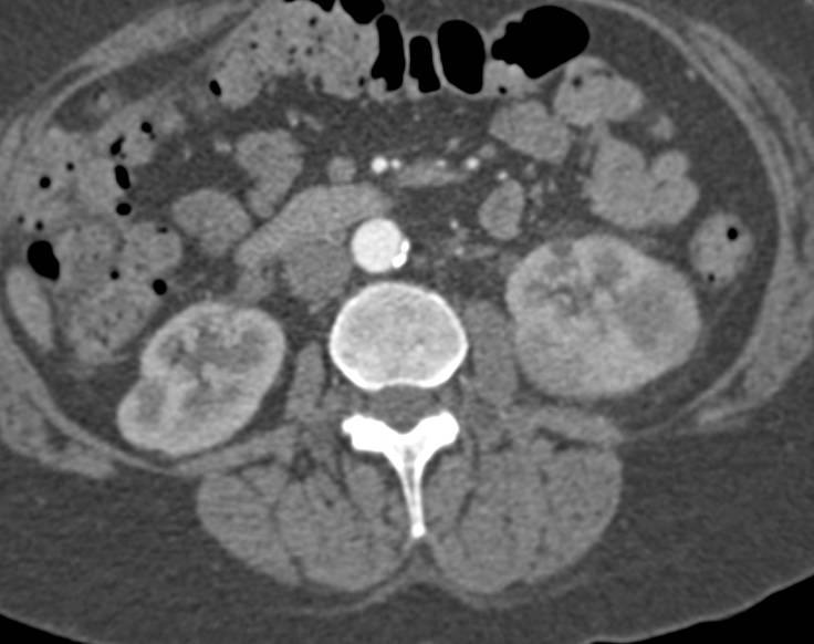 Acute Pyelonephritis Left Kidney Not Seen on Arterial Phase - CTisus CT Scan