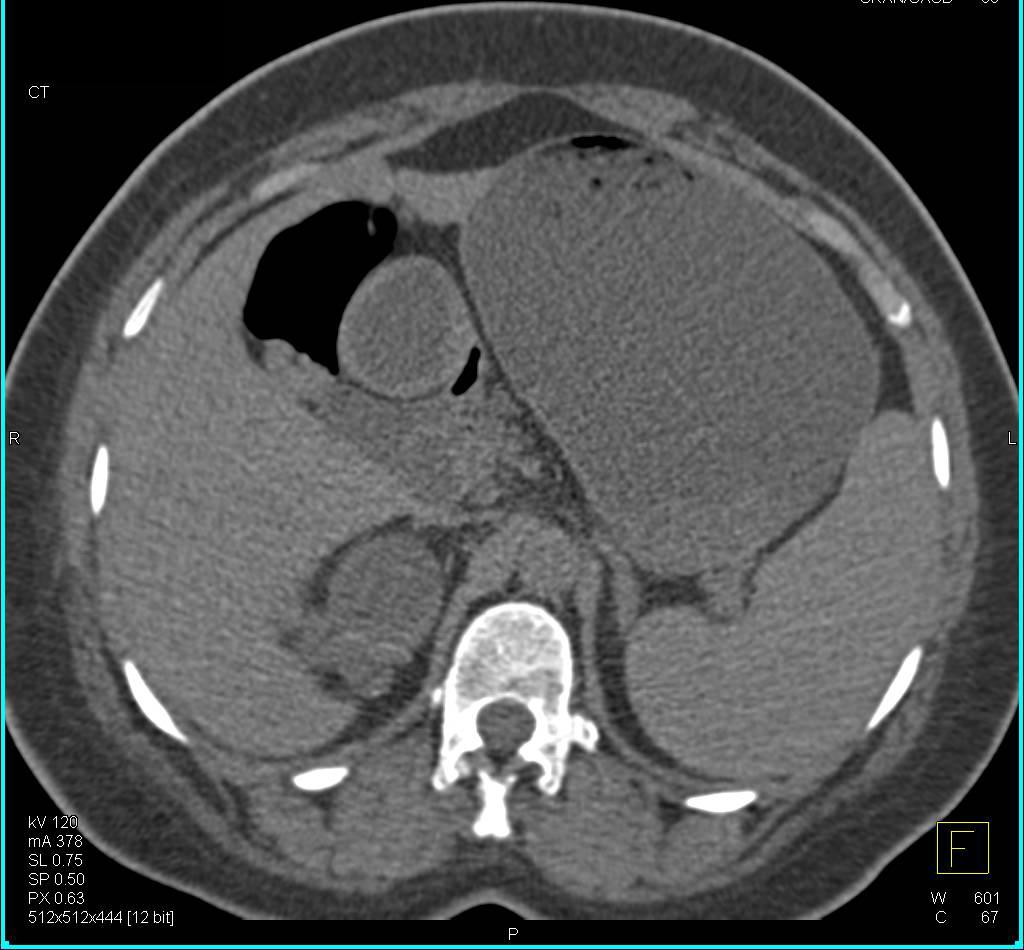 High Density Right Renal Cyst - CTisus CT Scan