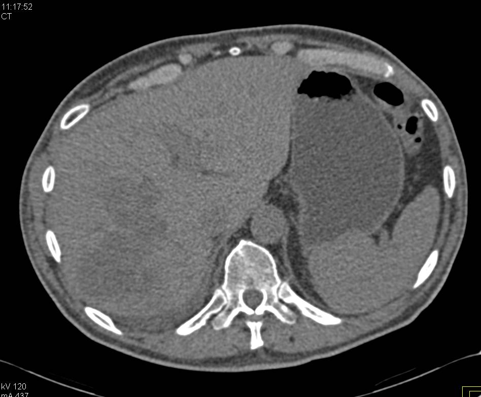 Renal Cell Carcinoma Right Kidney with Liver Metastases and Adenopathy - CTisus CT Scan