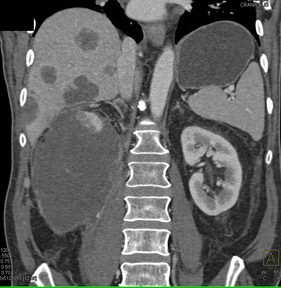Necrotic Renal Cell Carcinoma with Liver Metastases - CTisus CT Scan