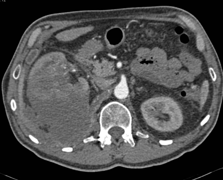 Necrotic Renal Cell Carcinoma with Local Adenopathy - CTisus CT Scan
