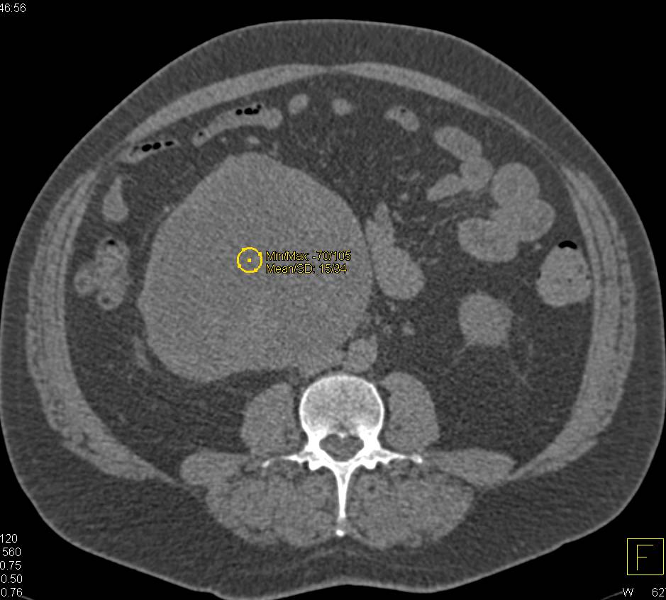 Cystic Renal Cell Carcinoma Displaces the Ureter - CTisus CT Scan