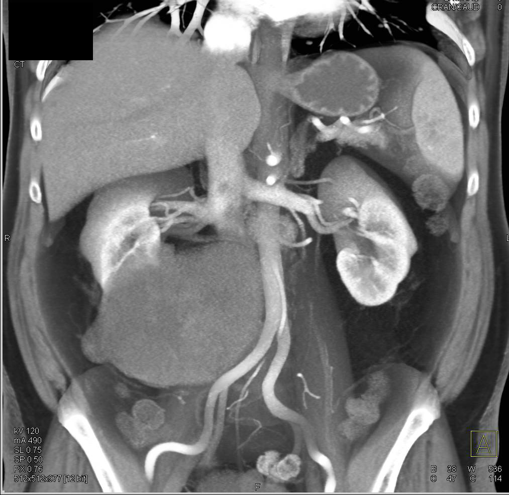 Cystic Renal Cell Carcinoma - CTisus CT Scan