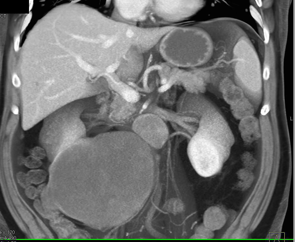 Cystic Renal Cell Carcinoma with Bone Metastases - CTisus CT Scan